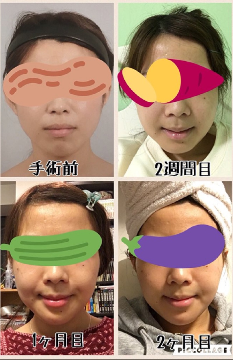 Japanese Cosplayer Buys 'Confidence' With 64,000 of Plastic Surgery