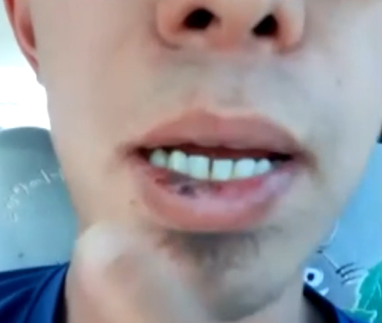 Man Suffers Cuts and Bruises After Getting Shot With PAINTBALLS in