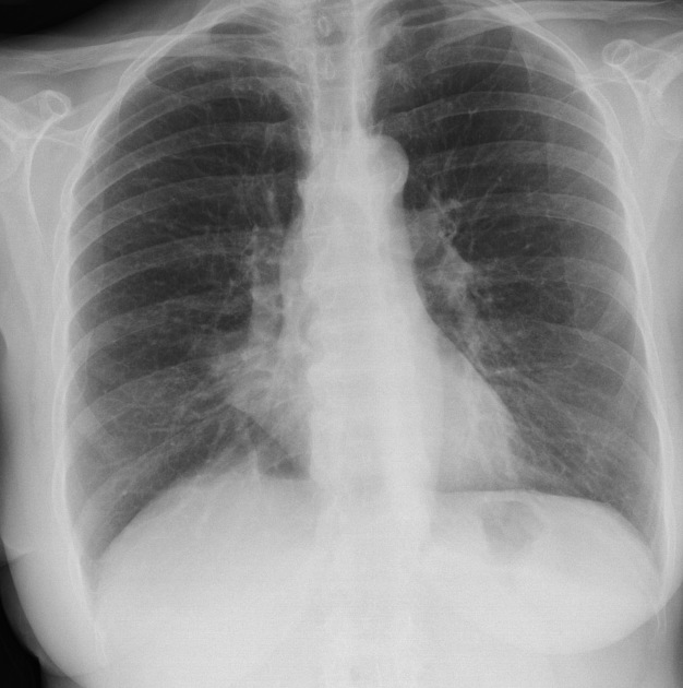 lobar lung collapse pacs