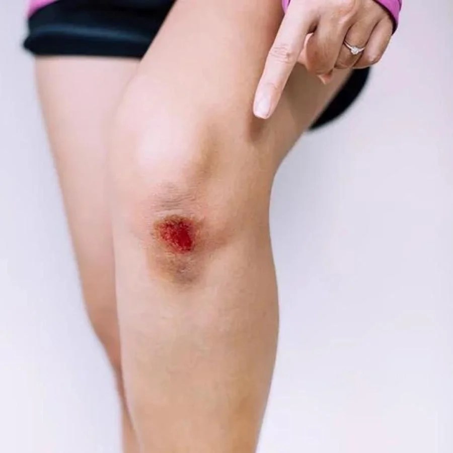 Wound Healing Guide How Your Body Repairs Skin Damage