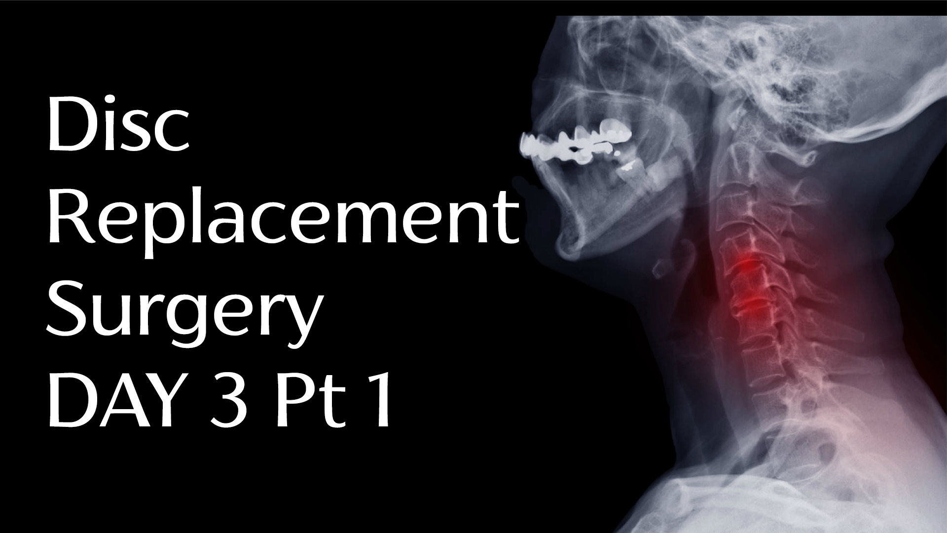 Cervical Disc Replacement Surgery Day 3 Part 1 Dr David Perna DC