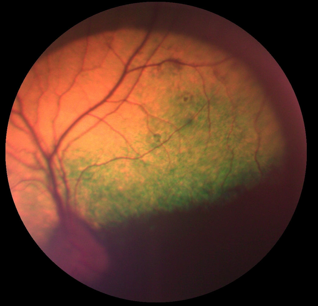 Retinopathy July 2015