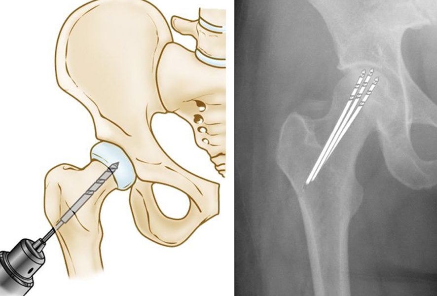 HIP AVASCULAR NECROSIS/OSTEONECROSIS Treatment