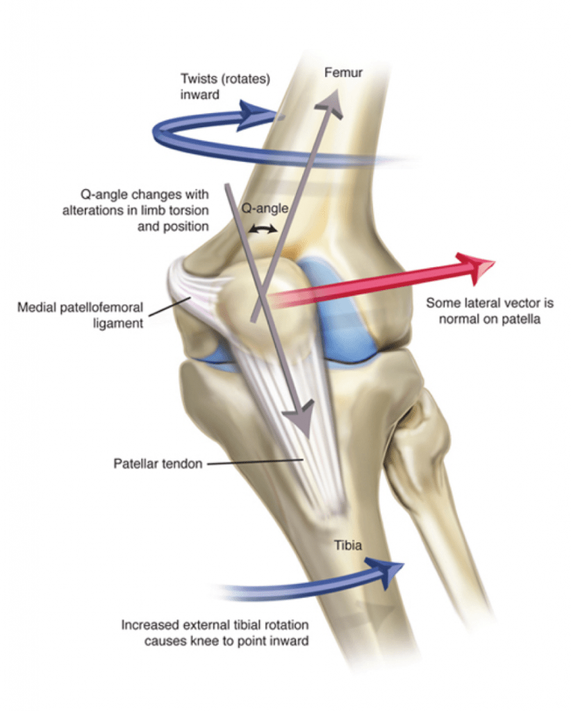 Causes of Patellar Dislocation & Instability (Unstable Kneecap)