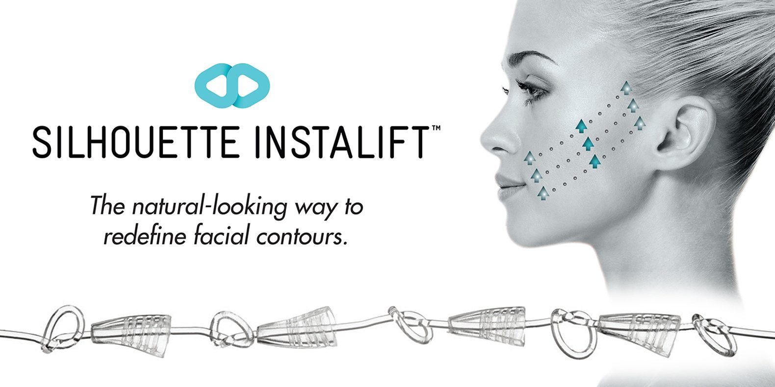 Silhouette Thread Lift in Richmond, BC DaVinci Cosmetic