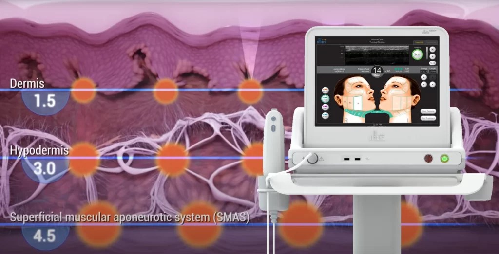 Ultherapy Treatment in Richmond, BC DaVinci Cosmetic