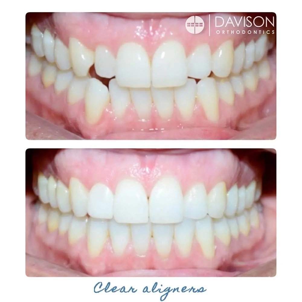Clear Aligners Davison Orthodontics