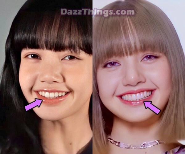 Lisa (Blackpink) Plastic Surgery Comparison Photos(01)