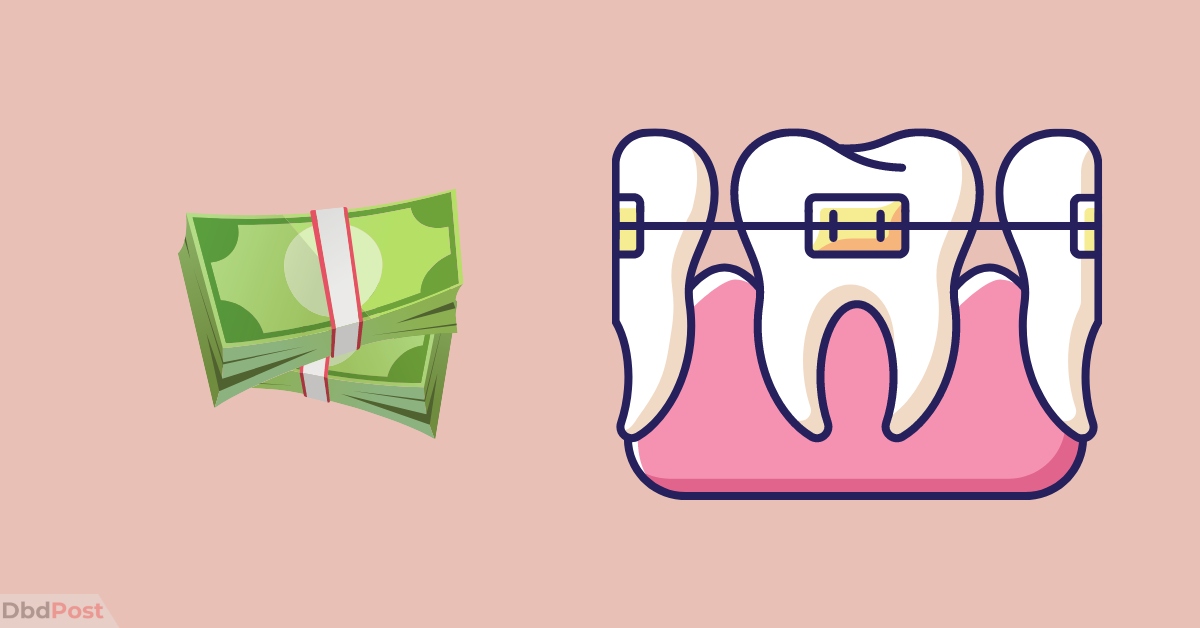 Permanent Retainer Cost in 2024 New, Repair & Removal Cost