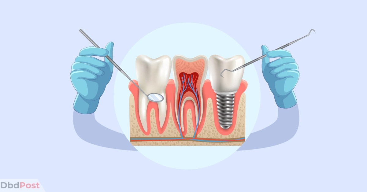 Root Canal Cost Average Cost & Additional Cost to Consider
