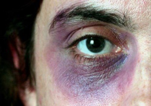 чем нарисовать синяк