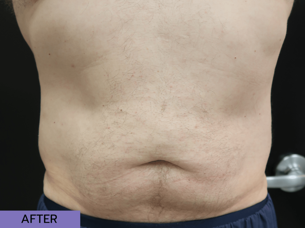 Emsculpt After DC Derm Docs