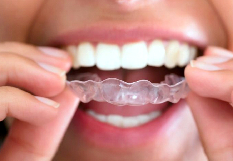 京都で歯ぎしり・食いしばり、睡眠時無呼吸症候群なら、山科区のなぎ辻デンタルクリニック