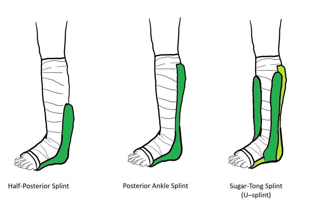 The Best Comprehensive Guide to Ankle Splints 2023 Durrell & Clifford