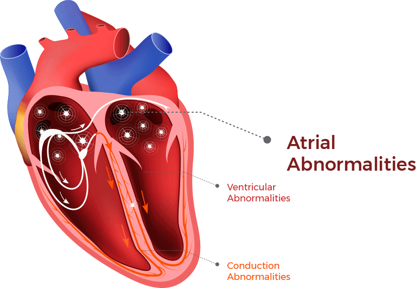 Atrial Fibrilliation (AFib) & Cardiomyopathy symptoms & treatment