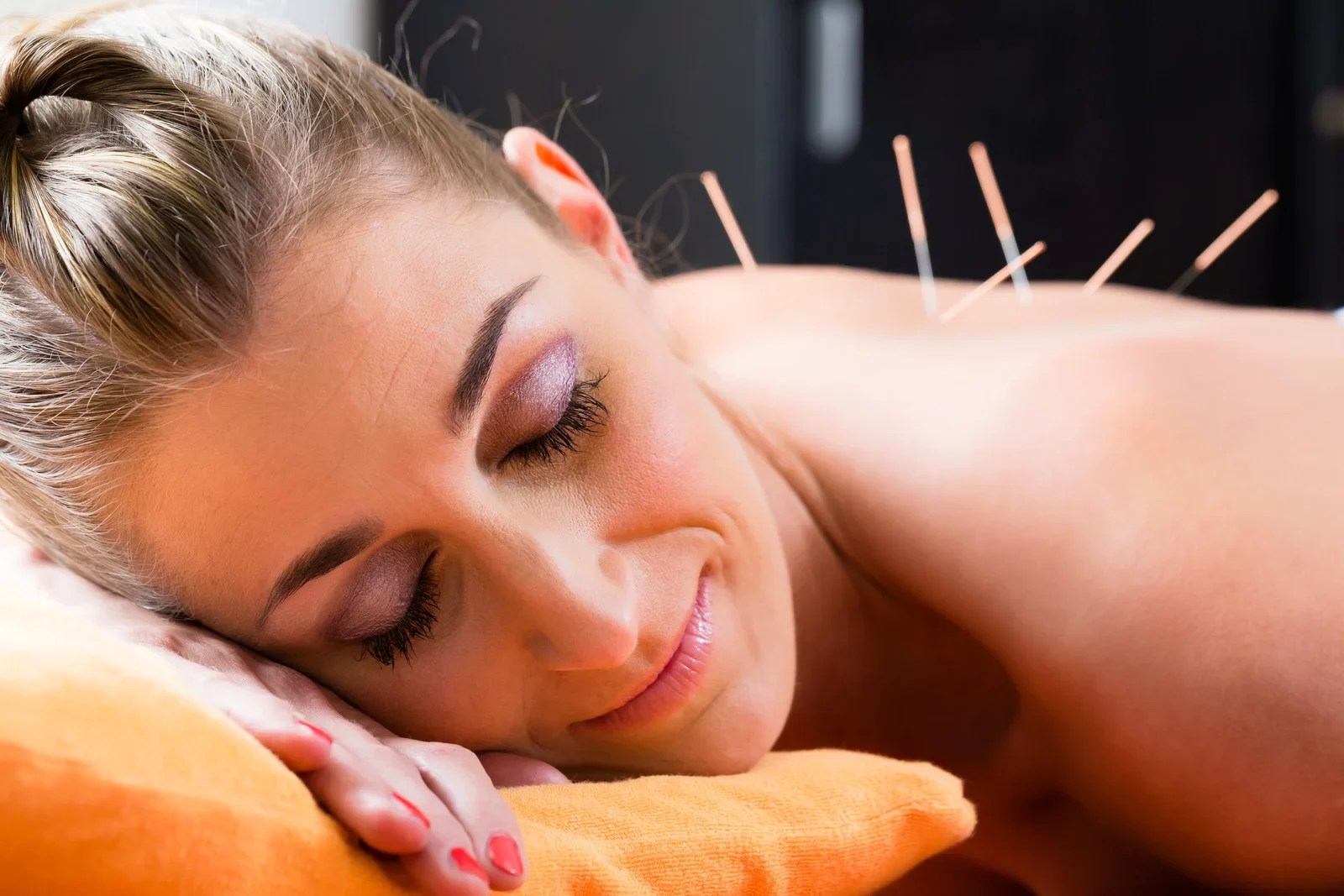 Dry Needling Treatments Willoughby Putney DC Physio