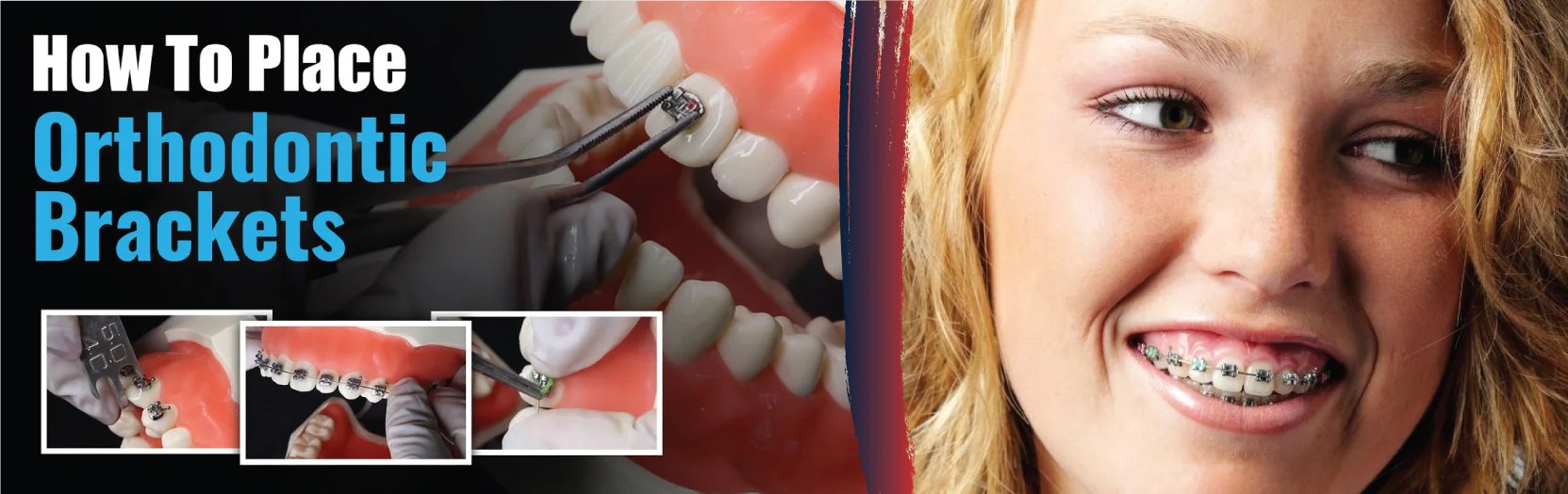 StepbyStep Process of Using Orthodontic Bracket Placers