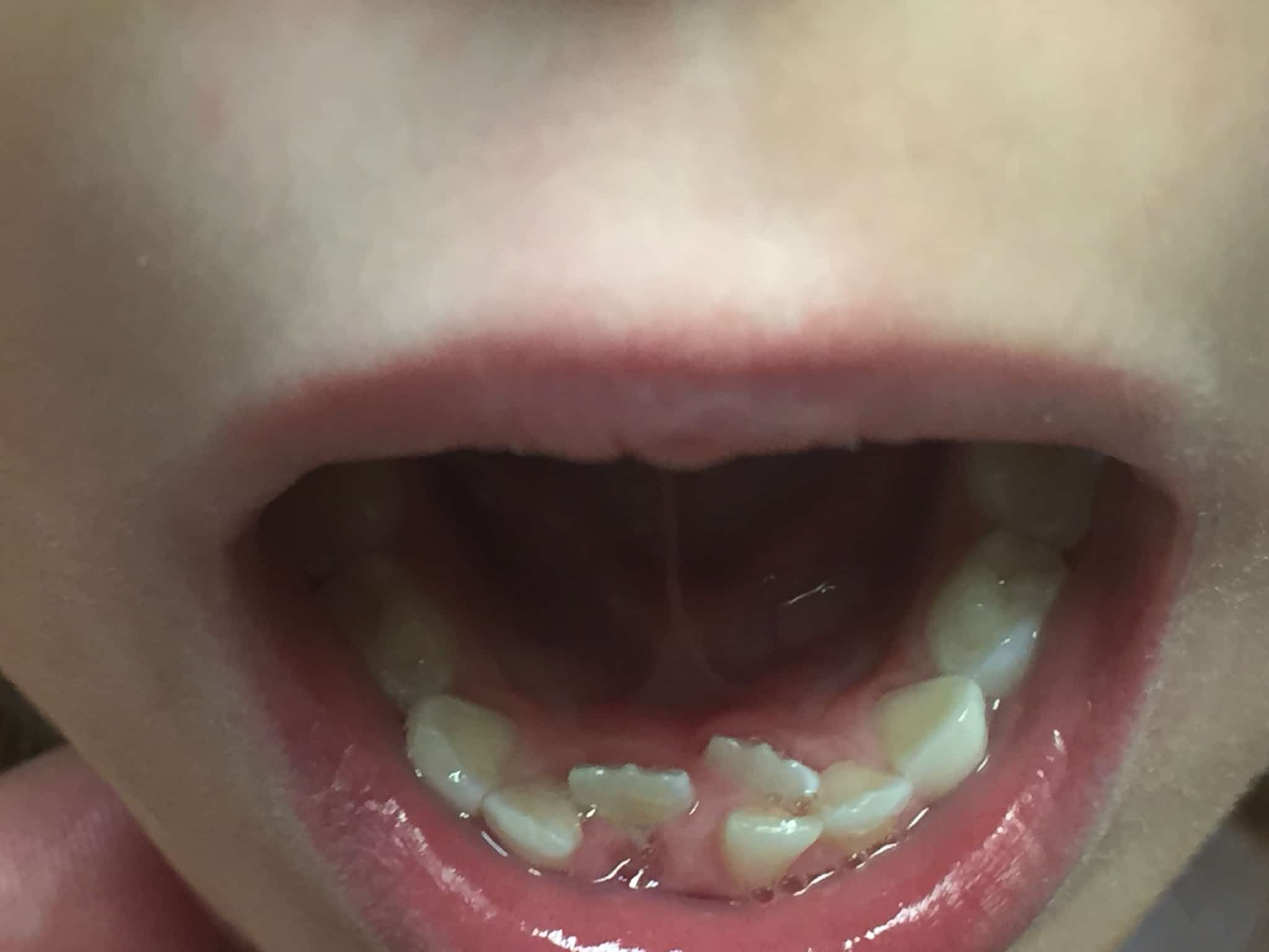 Do Your Kids Have Shark Teeth? ddschild