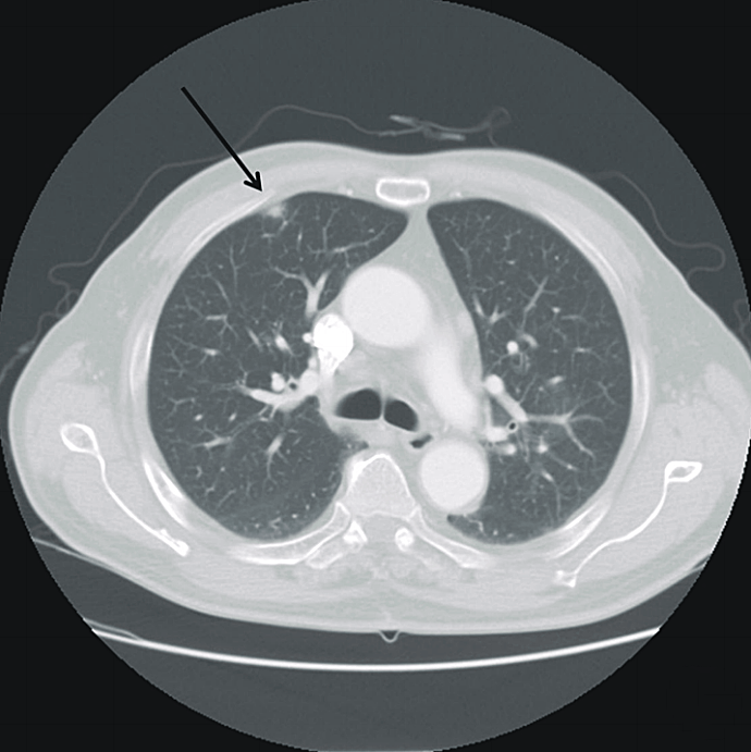 Differential Diagnosis of Quick Case Pleuritic Chest Pain