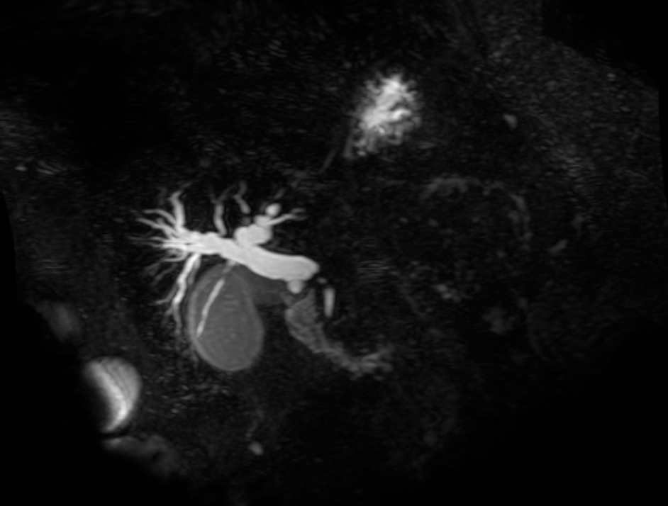 Differential Diagnosis of Hyperbilirubinemia