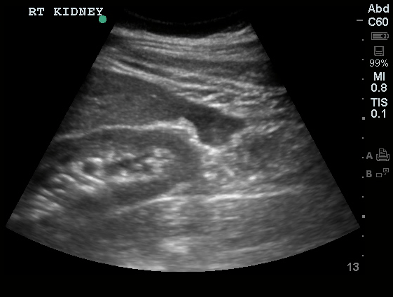 Differential Diagnosis of Ectopic Pregnancy