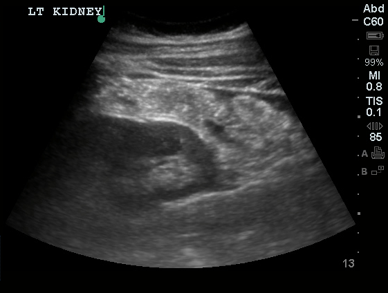 Differential Diagnosis of Ectopic Pregnancy