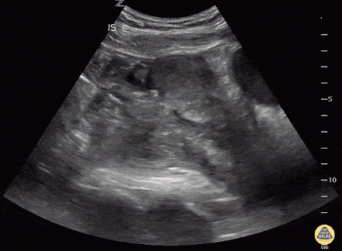 Ectopic Pregnancy Animation / Why Aren T Iuds As Popular As They Should