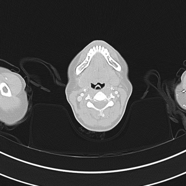 Differential Diagnosis of Wheezing and Stridor