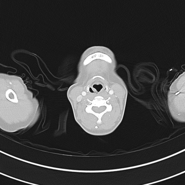 Differential Diagnosis of Wheezing and Stridor