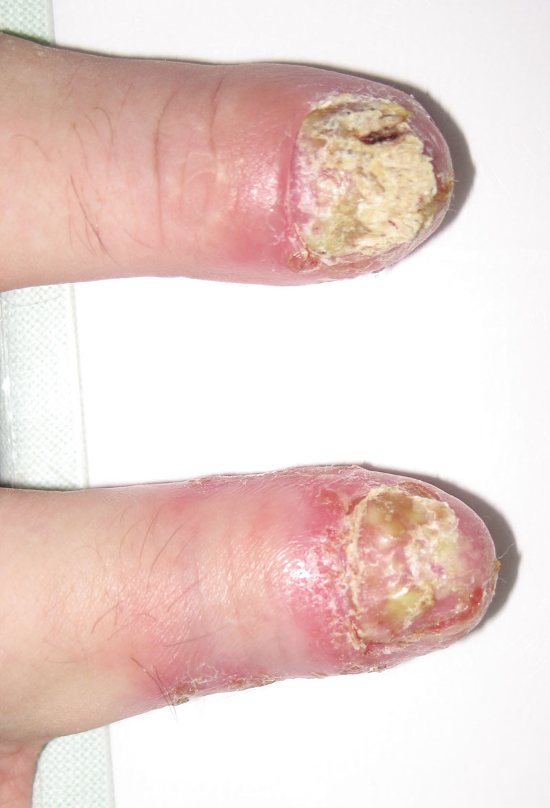 Medicle Organisation Psoriasis pustulosa