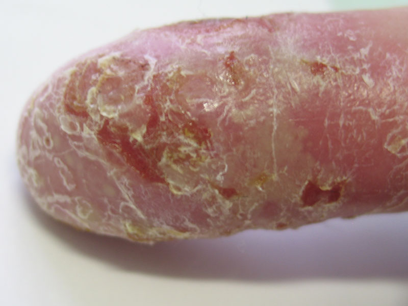 Medicle Organisation Psoriasis pustulosa