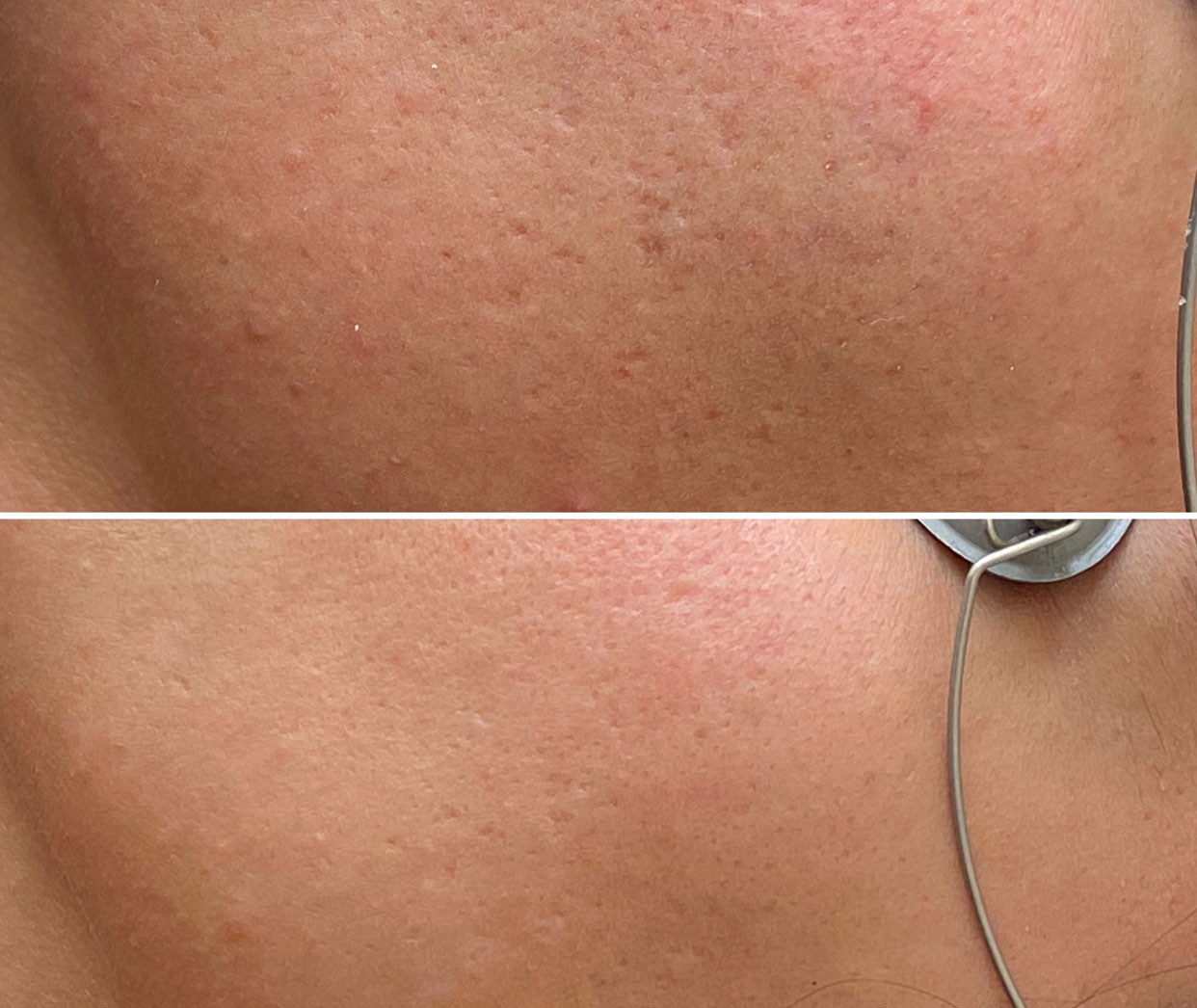 Laser Scar Treatments DEA Med Spa in Glendale CA