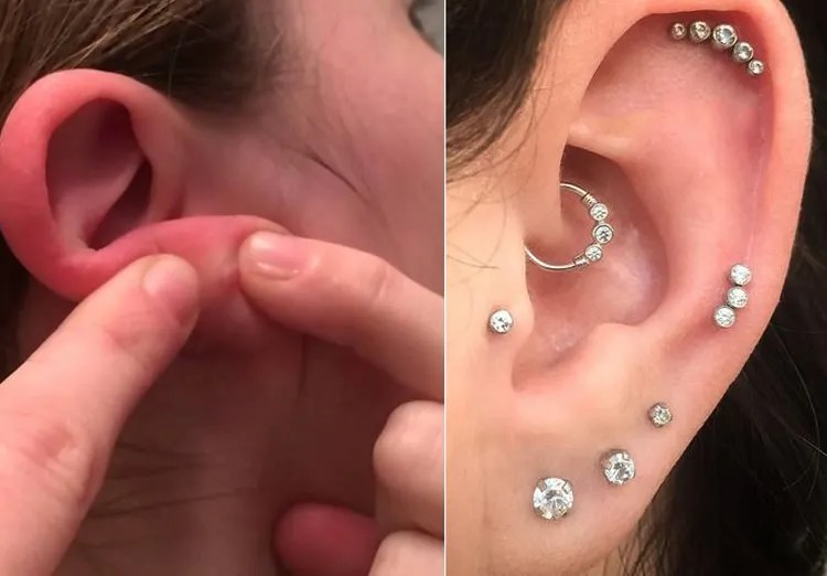 How to Clean Infected EarPiercing Heal the Wound Easily!