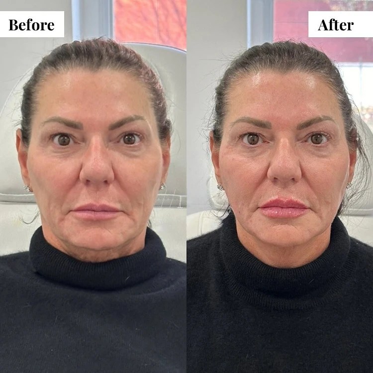 What Is an Ozempic Face Signs, Prevention & Treaments