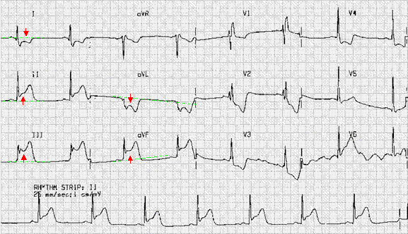 Morfologi st depresi dapat berbentuk menanjak, mendatar, atau menurun (boon et al., 2003). Belajar EKG | debar