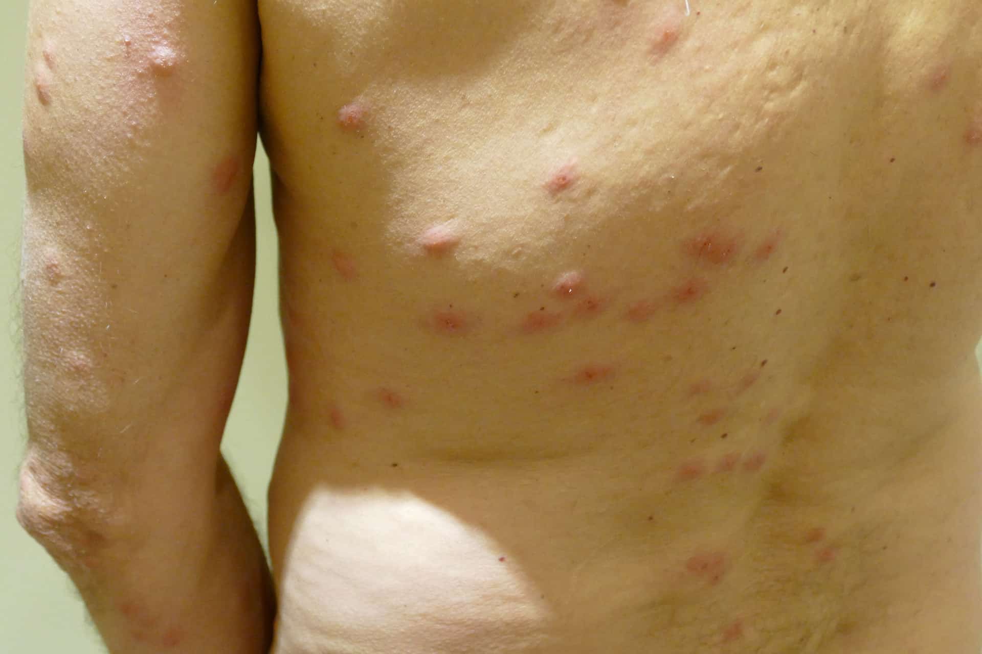 Pictures of Bed Bugs Bites on Real People Debedbug