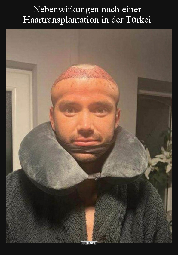 Nebenwirkungen nach einer Haartransplantation in der Türkei DEBESTE.de