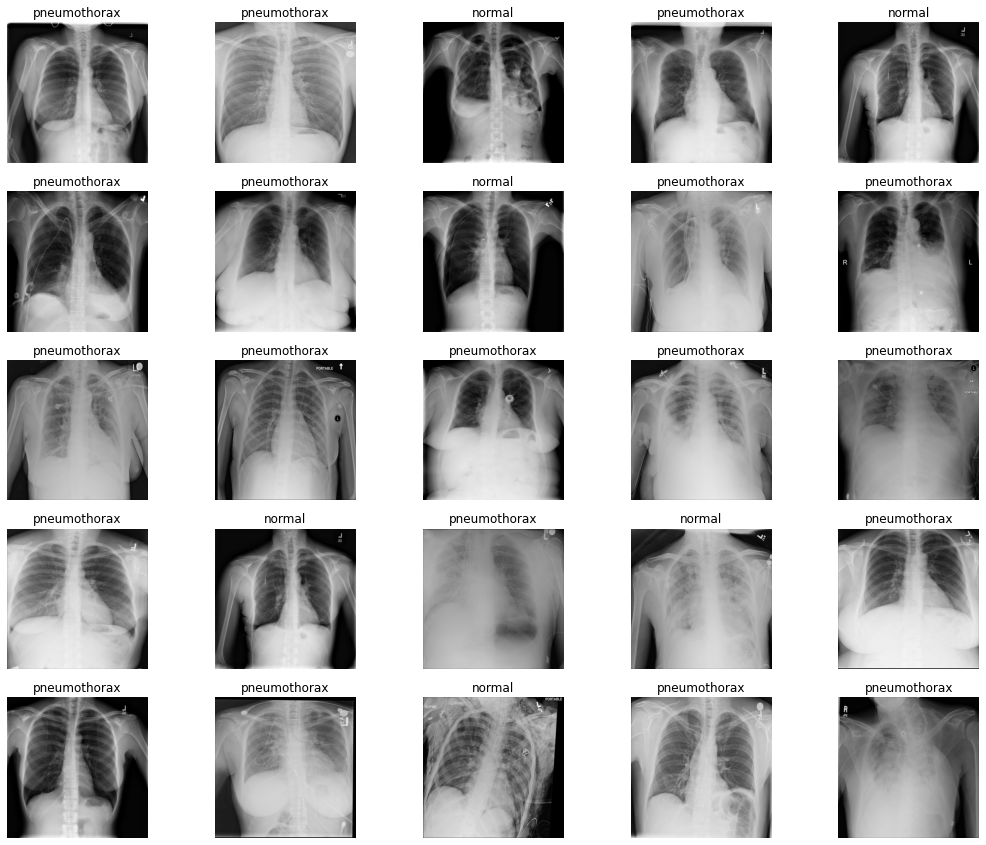 Pneumothorax Binary Classification using PyTorch Model Pretrained on
