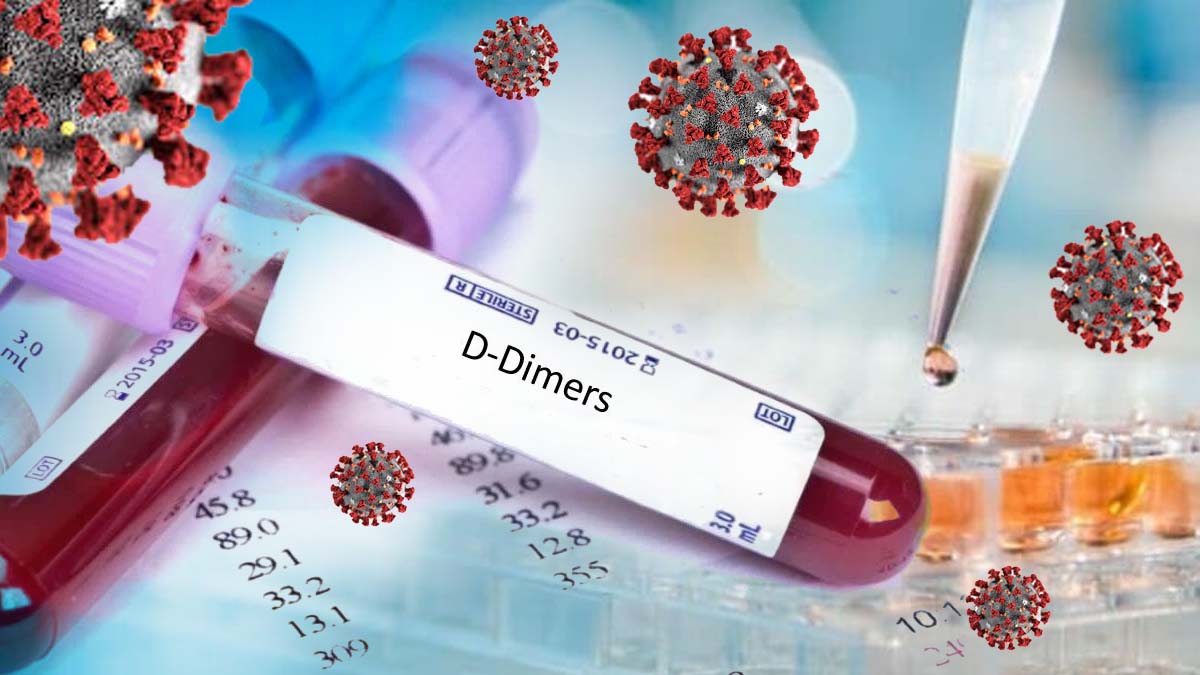 A Ddimer blood test is a useful way to identify COVID19 patients at a