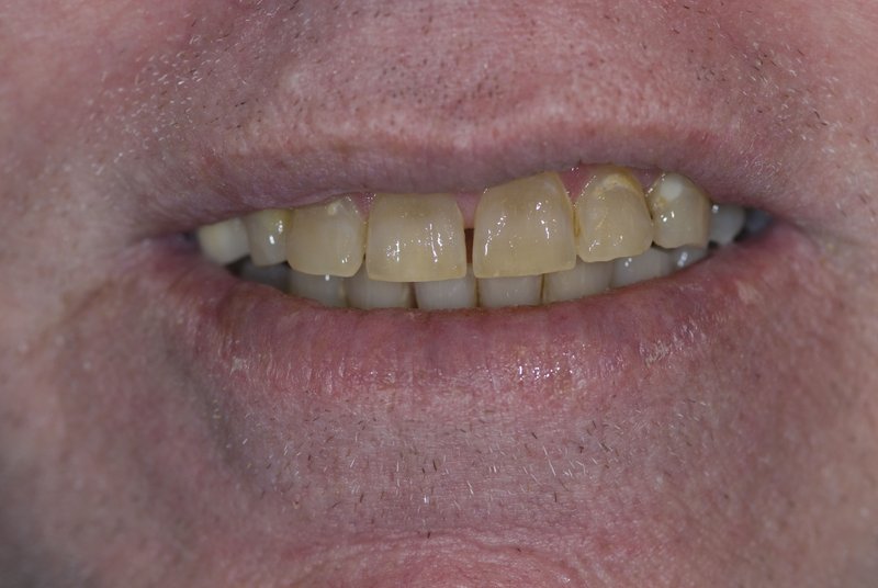 Dental Work Before and After Dentist in Decatur AL Decatur Smiles