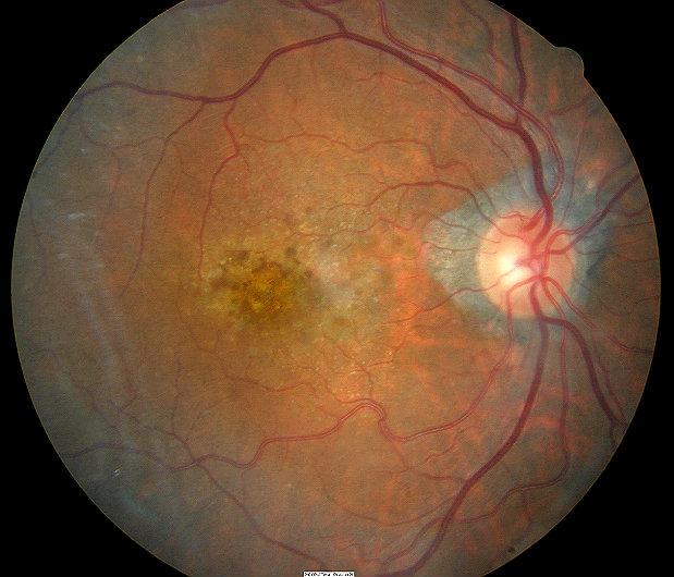 H35.31 Nonexudative Senile Macular Degeneration of Retina Decision