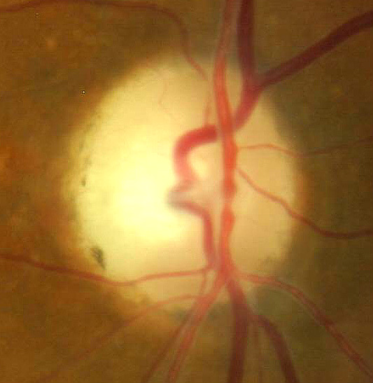 H47.291293 Partial Optic Atrophy DecisionMaker PLUS