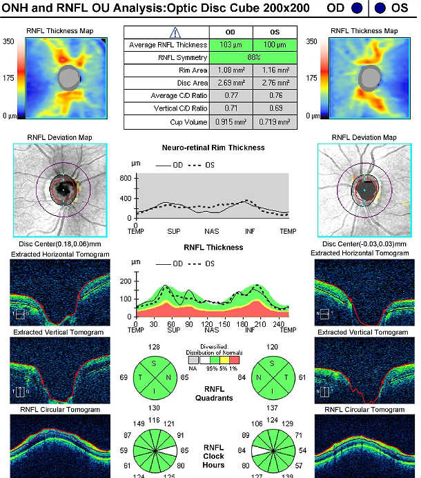Suspect Optic Nerve Cupping Icd 10 Astigmatism Swollen Eyes Disease