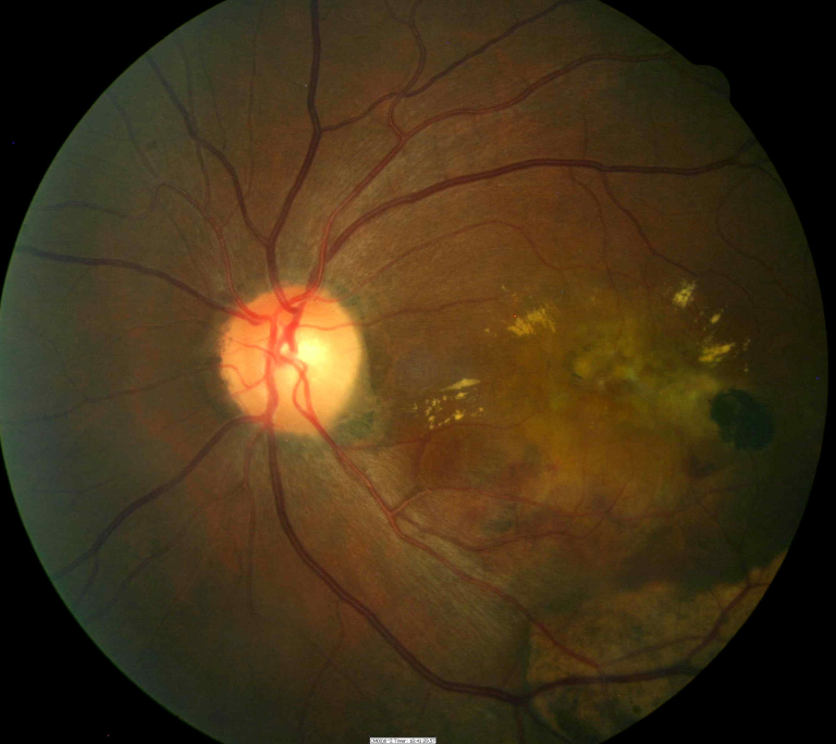 H35.32 Exudative Senile Macular Degeneration of Retina DecisionMaker