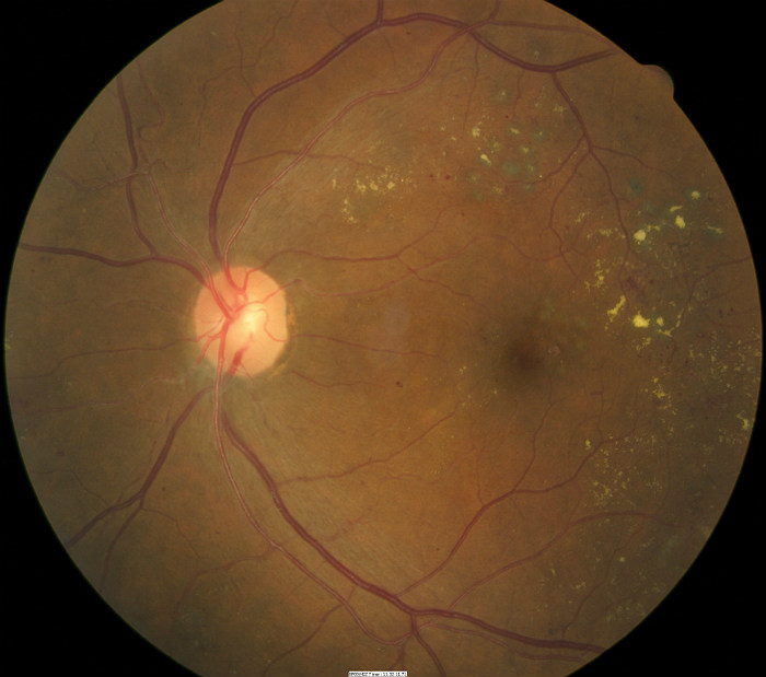 E11.321351 Diabetic Macular Edema DecisionMaker PLUS