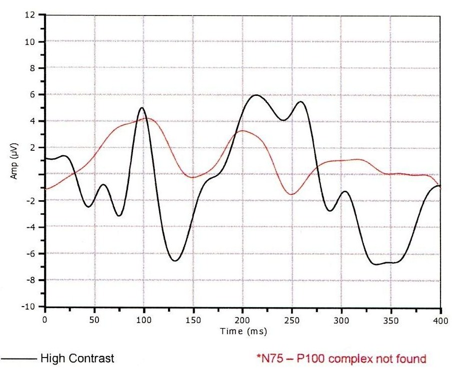 Optic Neuritis Secondary to Multiple Sclerosis DecisionMaker PLUS