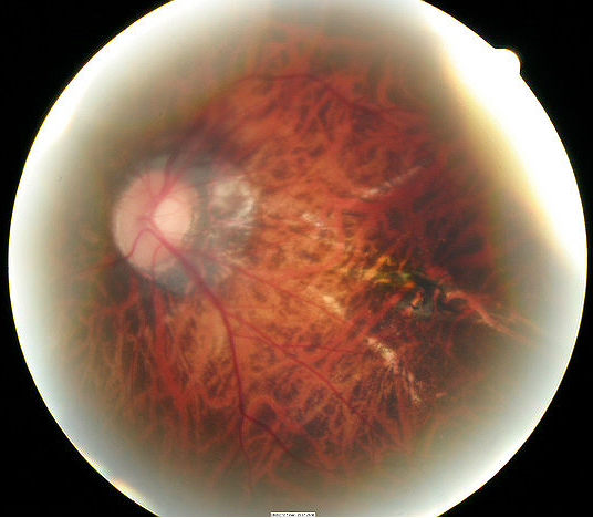 H44.2123 Progressive High (Degenerative) Myopia DecisionMaker PLUS