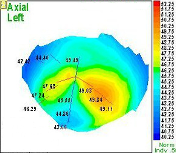 H52 211 213 Irregular Astigmatism Decision Maker Plus