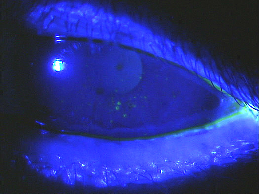 H16 121 123 Filamentary Keratitis Decision Maker Plus