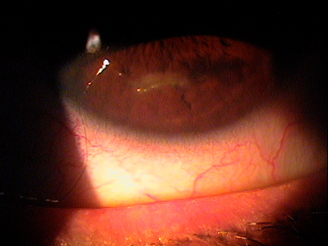 H18.821823 Corneal Disorder due to Contact Lens DecisionMaker PLUS